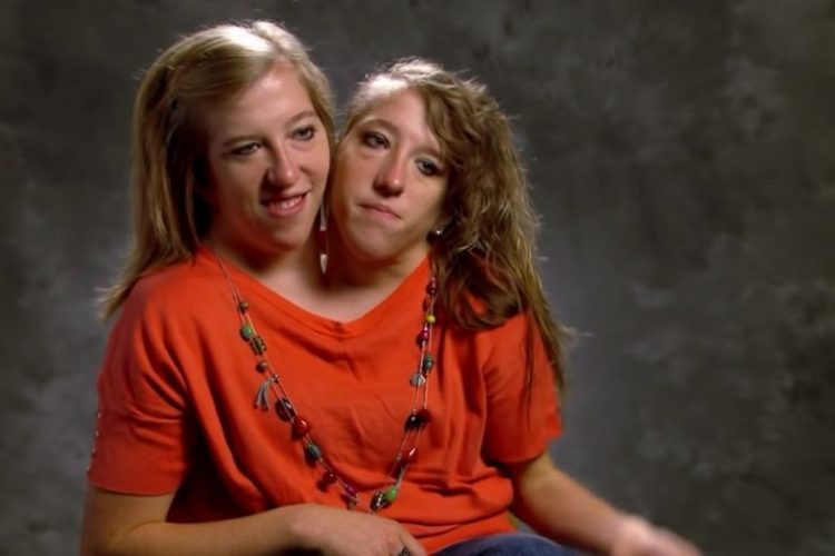 Schockierende Neuigkeiten Jahre nach der Geburt von siamesischen Zwillingen