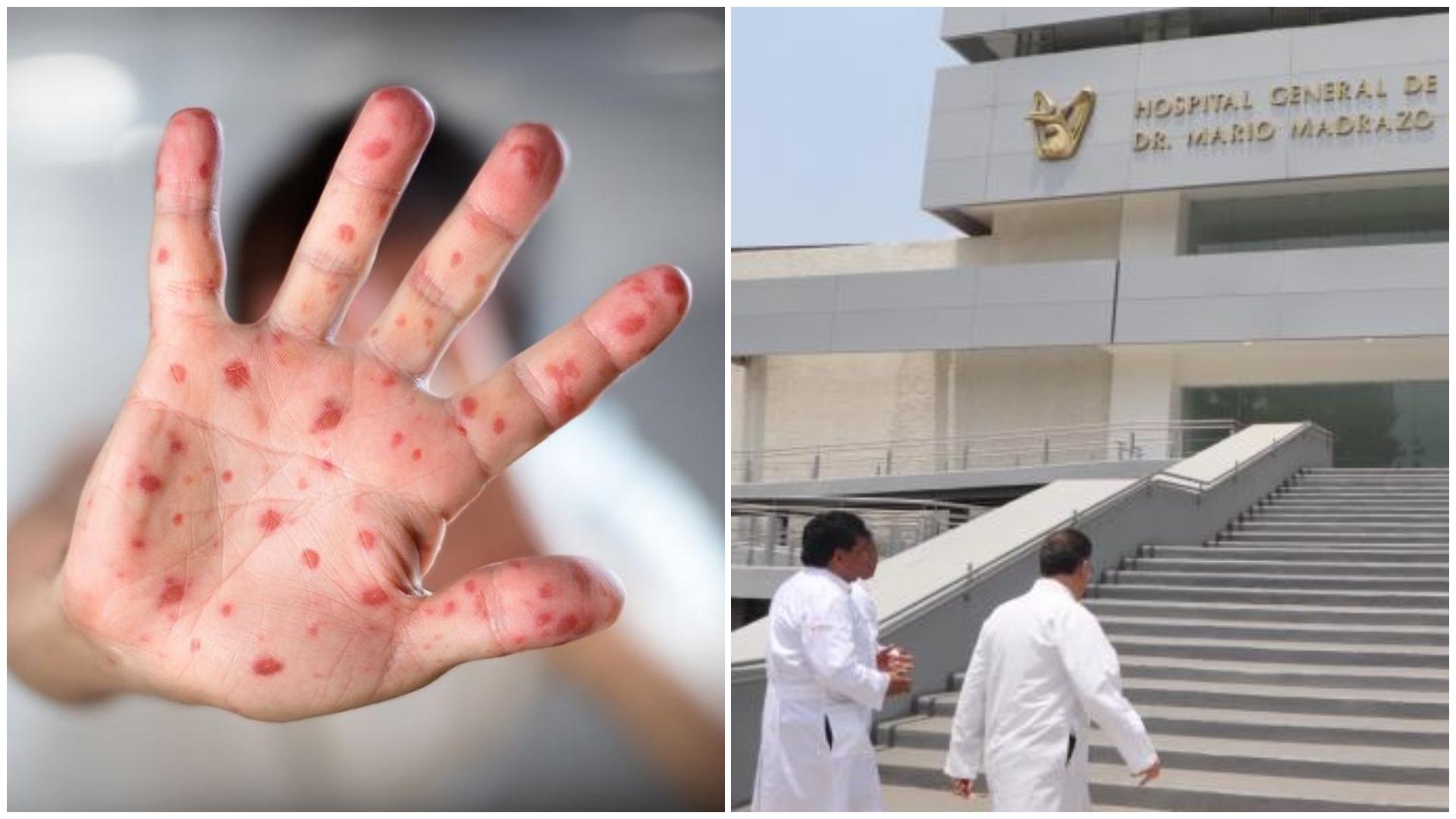 Virus Mpox Qué Enfermedad Se Ha Cobrado Ya Muchas Vidas En México Y Virus Mpox Qué Enfermedad Se Ha Cobrado Ya Muchas Vidas En México Y