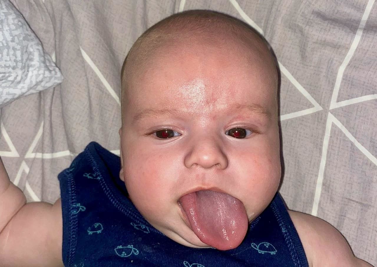 В Україні народився малюк з у 5 разів довшим за норму язиком: фото 
