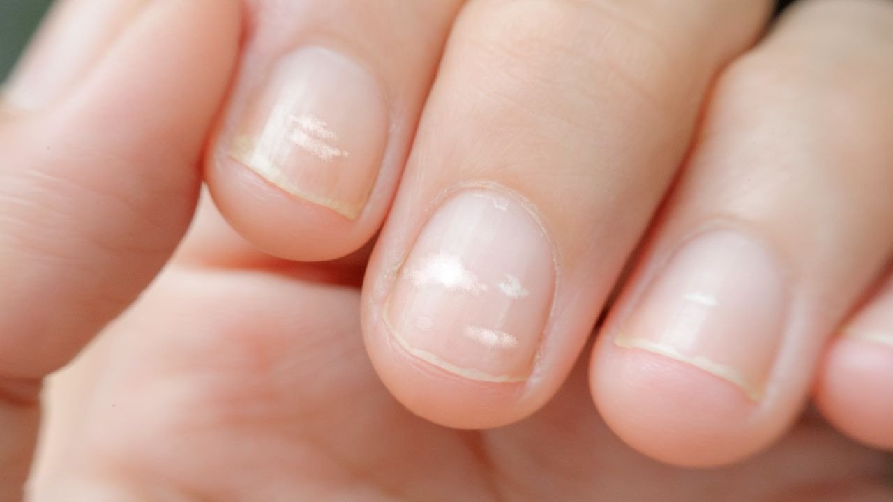 Warum Nägel geriffelt werden: ein lebenswichtiges Zeichen
