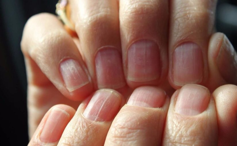 Por qué las uñas se acanalan: un signo vital ➤ Infotime.co