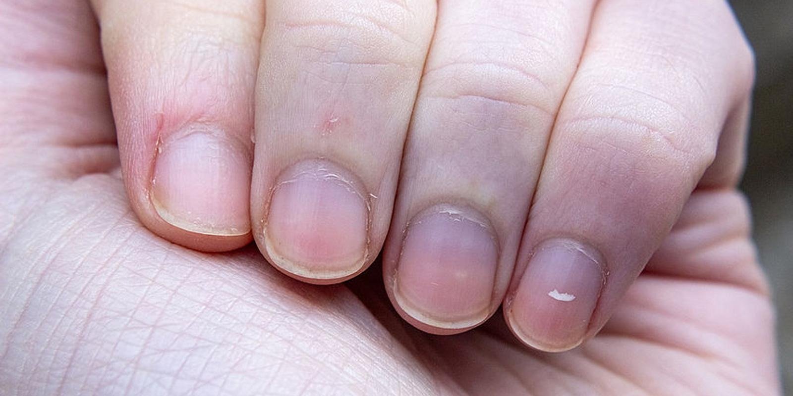 Warum Nägel geriffelt werden: ein lebenswichtiges Zeichen