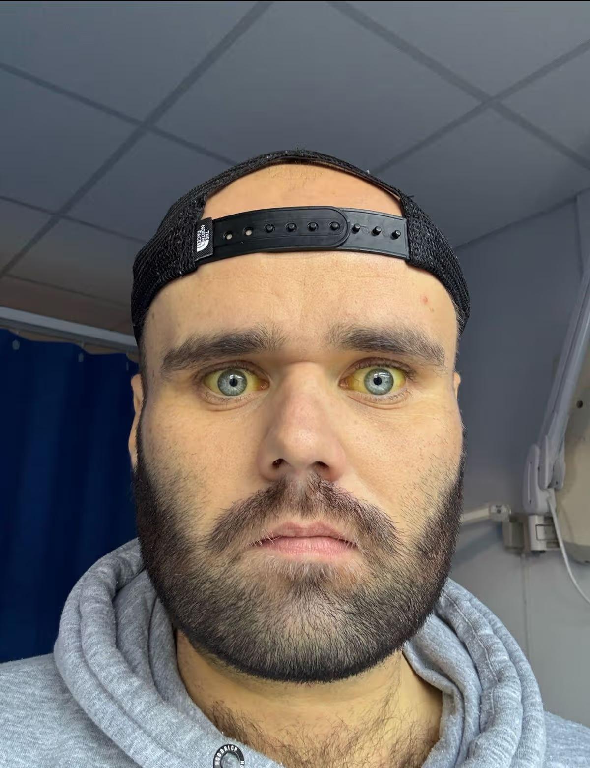 Чоловік щодня пив горілку і запивав шістьма пляшками вина: як це його змінило