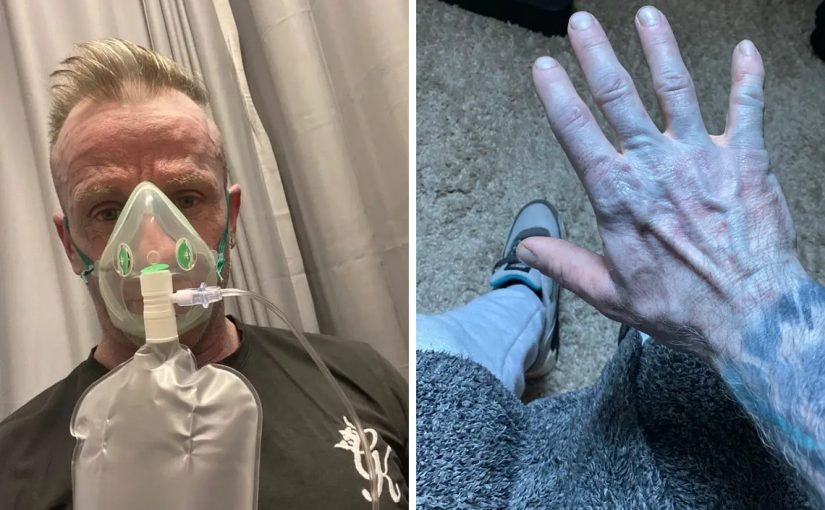 Прокинувся синім: британець налякав лікарів дивною “хворобою” (фото) ➤ Infotime.co