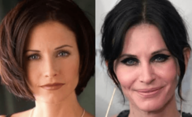 Prominente, deren Schönheitsoperationen für Aufsehen sorgten: Was Experten sagen