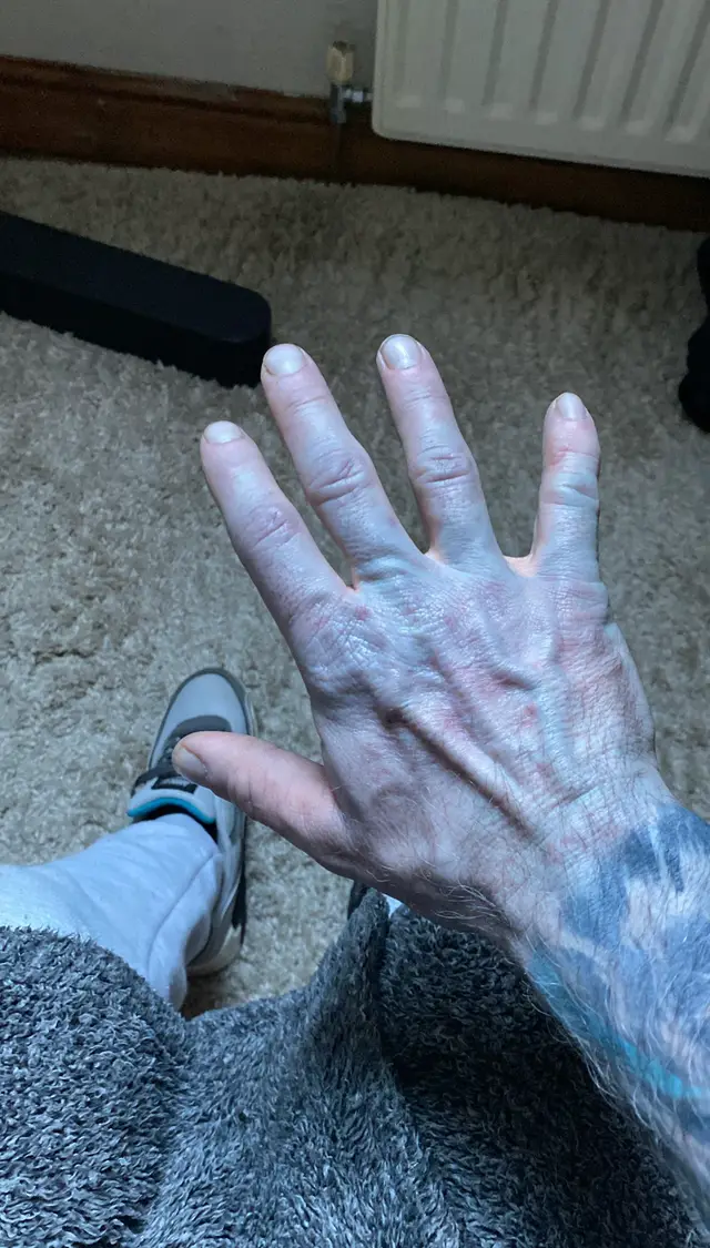 Прокинувся синім: британець налякав лікарів дивною “хворобою” (фото)