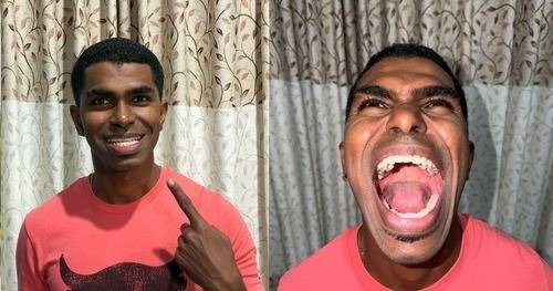 Ein Malaysier hat 42 Zähne – zehn mehr als der Durchschnittsmensch ➤ Infotime.co