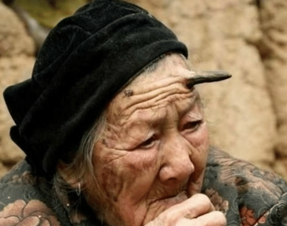 Einer 101-jährigen Frau wuchs ein echtes „Horn“ auf der Stirn – und was die Ärzte entdeckten, überraschte selbst die Experten